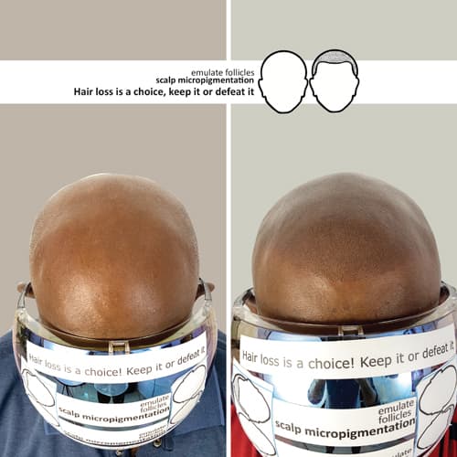 Manoj's Before and After Pictures of Scalp Micropigmentation Treatment