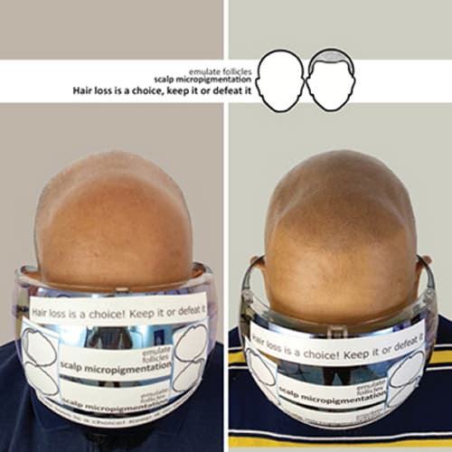 Raghu's Before and After Pictures of Scalp Micropigmentation Treatment