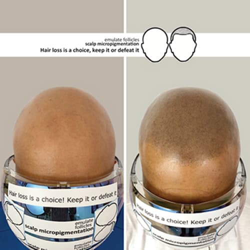 Rahul's Before and After Pictures of Scalp Micropigmentation Treatment