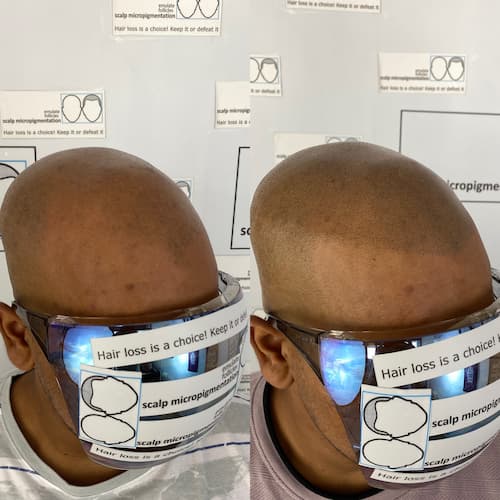 Abhinand Before and After Pictures of Scalp Micropigmentation