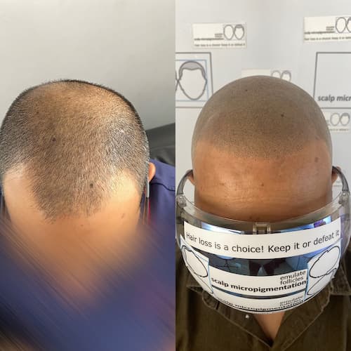 Jayaprashant Before and After Pictures of Scalp Micropigmentation