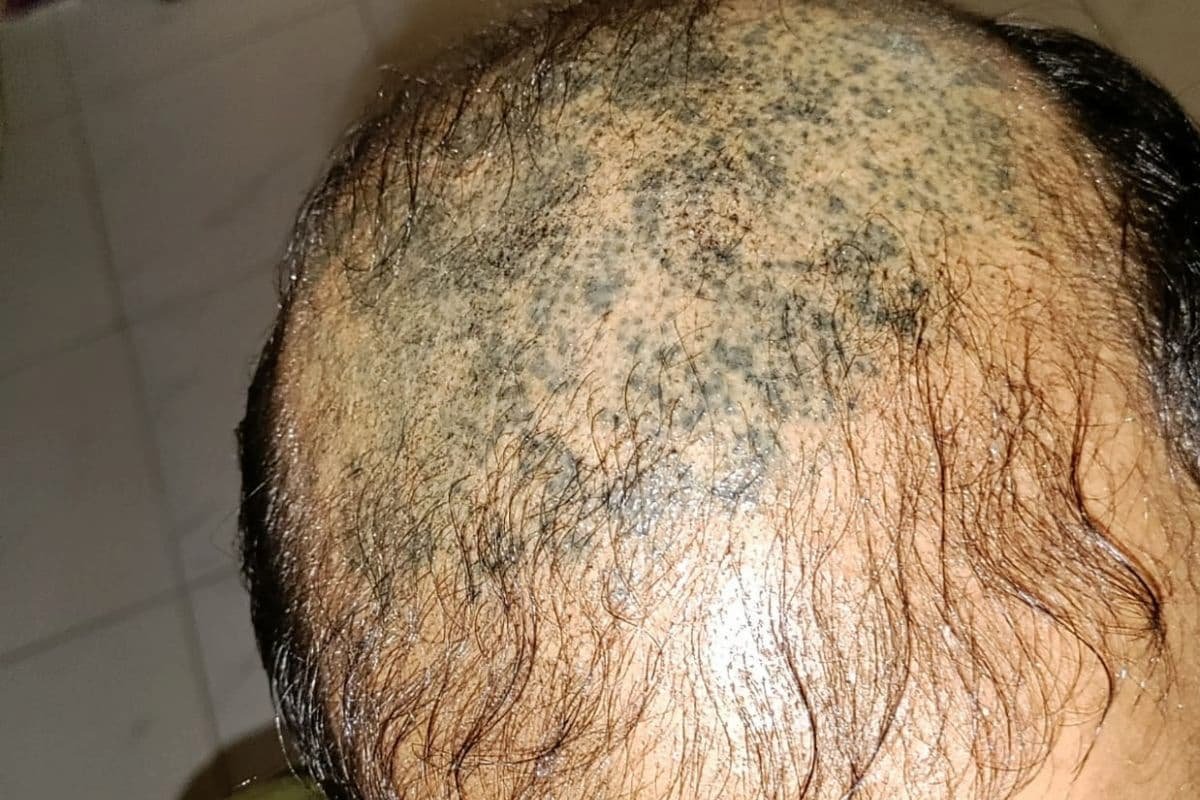 Is cheap scalp micropigmentation worth the risk
