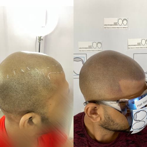 ashwin-before-and-after-pictures-of-scalp-micropigmentation