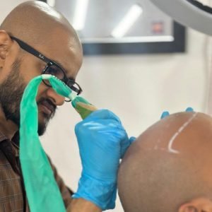 scalp-micropigmentation-procedure