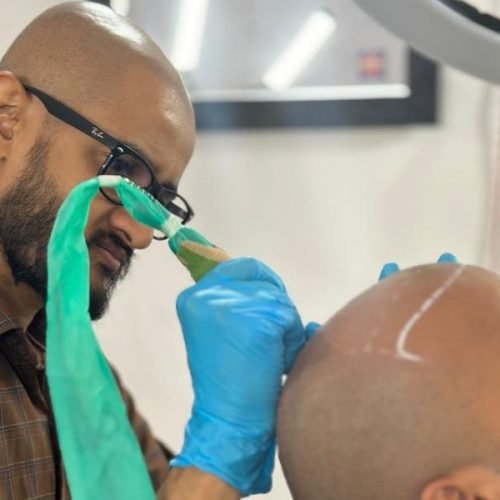 scalp-micropigmentation-procedure
